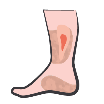 Venous leg ulcer icon