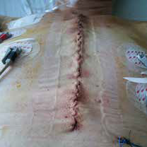 incision site