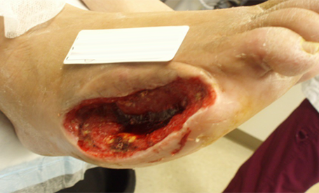 foot wound